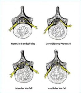 Symptome Bandscheibenvorfall lumbal - Besonderheiten in der LWS