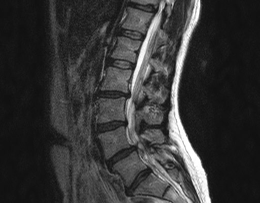 Synovialzyste sagittal MRT