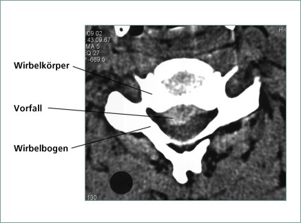 CT Aufnahme einer HWS