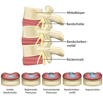 Entstehung eines Bandscheibenvorfalls