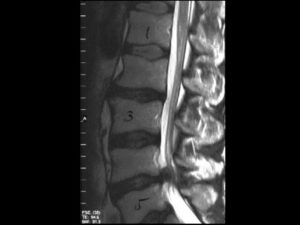 MRT der Wirbelsäule bei einem Bandscheibenvorfall