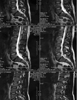 MRT der LWS bei Spondylolisthesis