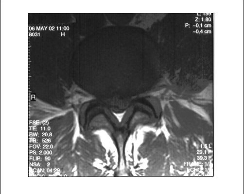 MRT der Lendenwirbelsaeule axial