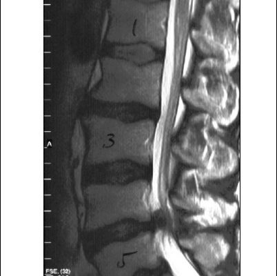 MRT der Lendenwirbelsaeule mit Bandscheibenvorfall