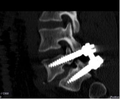 Spondylodese in der Höhe LWK 5/SWK 1 mit Pedikelschrauben (PLIF)