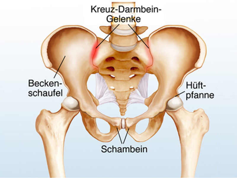 Iliosakralgelenks Syndrom übersicht