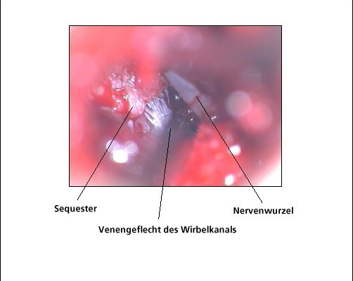 Intraoperatives Bild durch das OP-Mikroskop