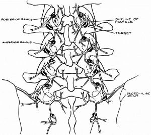 Eine Zeichnung der Lendenwirbelsäule von hinten. Hervorgehoben sind die Nervenbahnen die bei degenerativen Veränderungen den Schmerz leiten. Diese Schmerzbahnen müssen bei der CT gesteuerten Schmerztherapie anvisiert und getroffen werden.