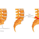 Bei der "echten" Spondylolisthesis der LWS kommt es zu einer Lyse, der Unterbrechung des Isthmus des Wirbelbogens; der Wirbelkörper gleitet nach vorne. Diese Spondylolisthesis vera unterscheidet man von der Pseudospondylolisthesis.