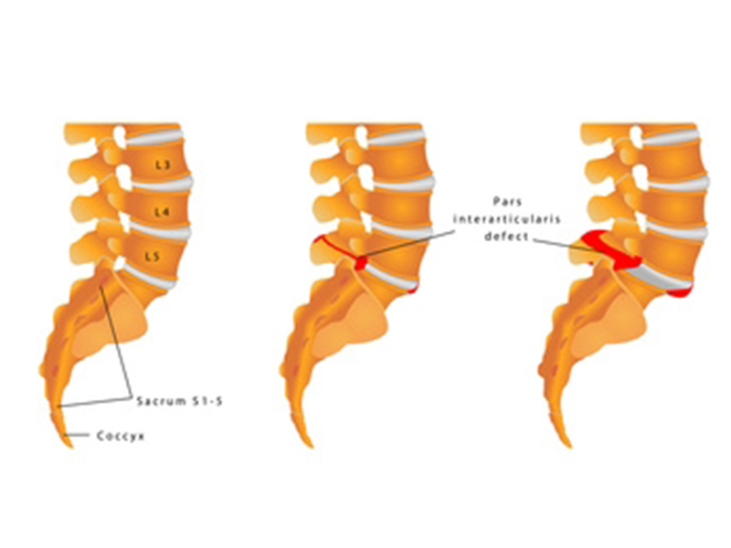 Bei der "echten" Spondylolisthesis der LWS kommt es zu einer Lyse, der Unterbrechung des Isthmus des Wirbelbogens; der Wirbelkörper gleitet nach vorne. Diese Spondylolisthesis vera unterscheidet man von der Pseudospondylolisthesis.