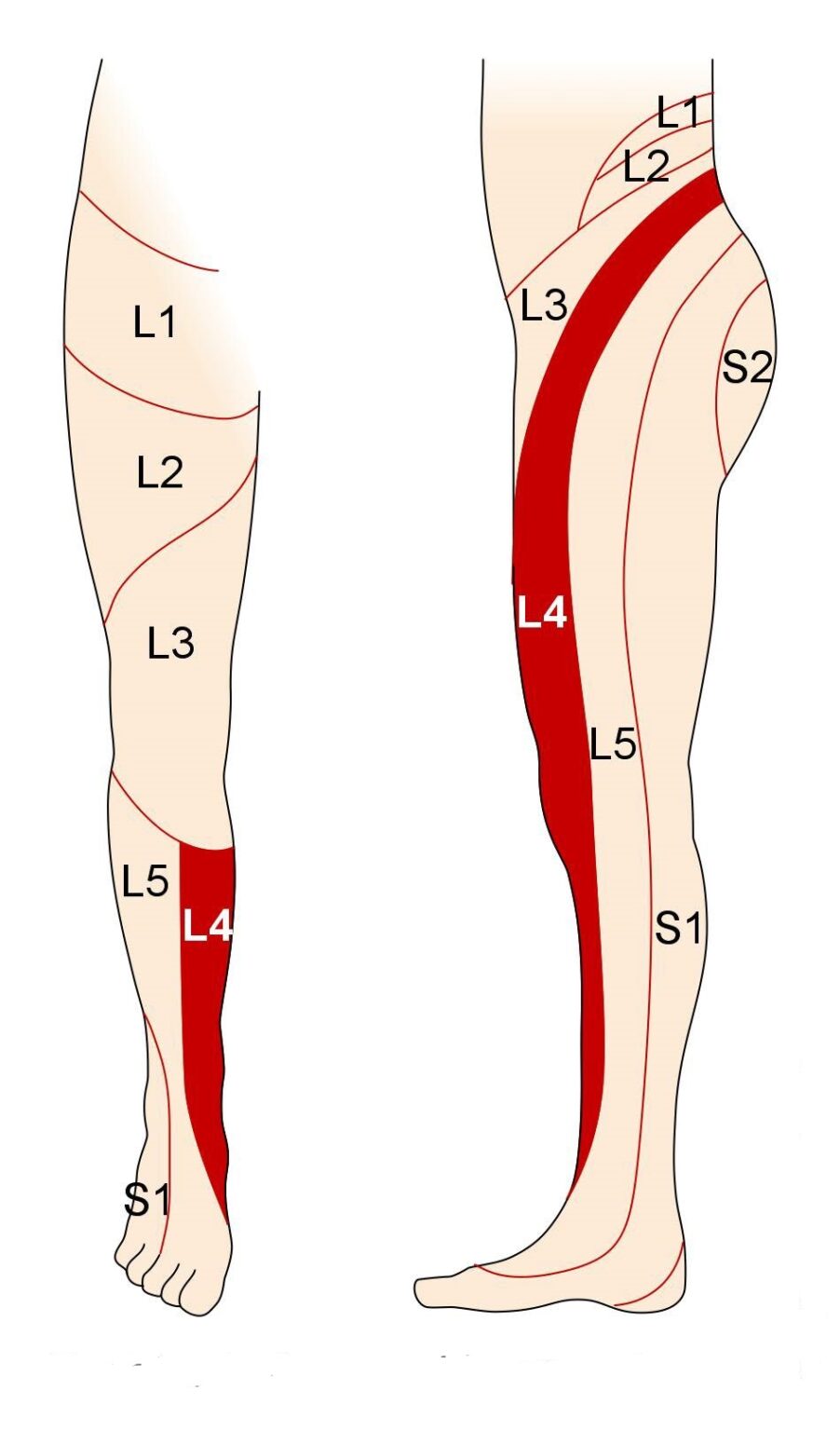 Bandscheibenvorfall L3/L4 und L4/L5 - Symptome und Befunde